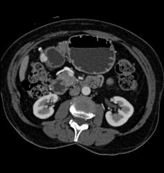 Antral Carcinoma With Gastric Outlet Obstruction - CTisus CT Scan