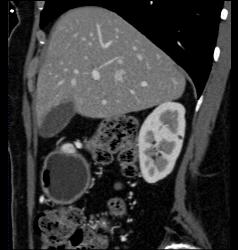 Antral Carcinoma With Gastric Outlet Obstruction - CTisus CT Scan