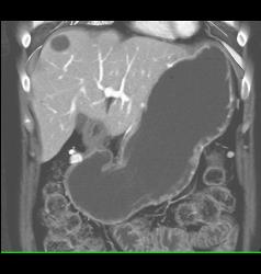 Antral Carcinoma With Gastric Outlet Obstruction - CTisus CT Scan