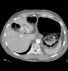 Emphysematous Gastritis - CTisus CT Scan