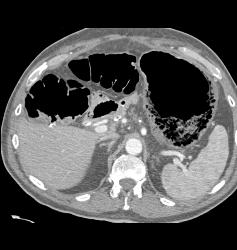 Emphysematous Gastritis - CTisus CT Scan