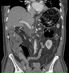 Emphysematous Gastritis - CTisus CT Scan