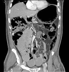 Emphysematous Gastritis - CTisus CT Scan