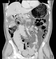 Emphysematous Gastritis - CTisus CT Scan