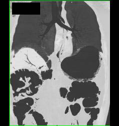 Emphysematous Gastritis - CTisus CT Scan