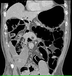 Emphysematous Gastritis - CTisus CT Scan