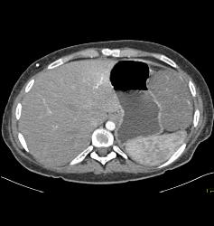 GIST Tumor - CTisus CT Scan