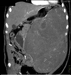 GIST Tumor - CTisus CT Scan