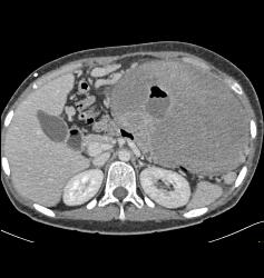 Ulcerating GIST Tumor - CTisus CT Scan