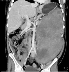 Ulcerating GIST Tumor - CTisus CT Scan