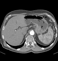 Ulcerating Gastric Adenocarcinoma - CTisus CT Scan