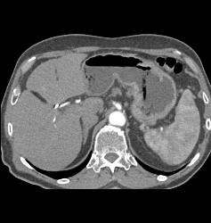 Ulcerating Gastric Adenocarcinoma - CTisus CT Scan