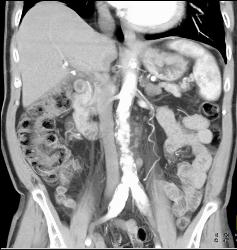 Ulcerating Gastric Adenocarcinoma - CTisus CT Scan