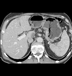 Ulcerating Gastric Adenocarcinoma - CTisus CT Scan