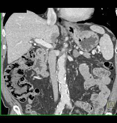 Ulcerating Gastric Adenocarcinoma - CTisus CT Scan