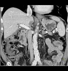 Ulcerating Gastric Adenocarcinoma - CTisus CT Scan