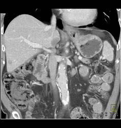 Ulcerating Gastric Adenocarcinoma - CTisus CT Scan