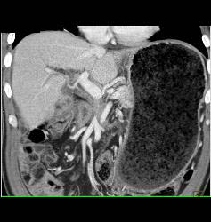 Gastric Outlet Obstruction Due to Carcinoma - CTisus CT Scan