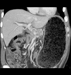 Gastric Outlet Obstruction Due to Carcinoma - CTisus CT Scan