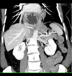 Para-esophageal Hernia With Intra-thoracic Stomach - CTisus CT Scan