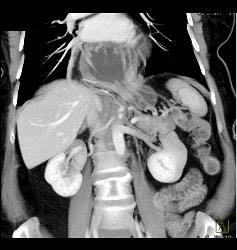 Para-esopheagal Hernia With Intra-thoracic Stomach - CTisus CT Scan