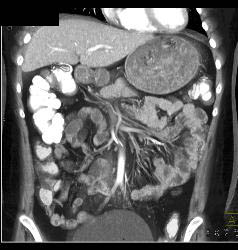 Stomach Full of Food Due to Gastric Outlet Obstruction - CTisus CT Scan