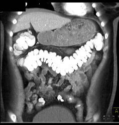 Stomach Full of Food Due to Gastric Outlet Obstruction - CTisus CT Scan