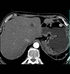 Metastatic Renal Cell Carcinoma to the Stomach - CTisus CT Scan