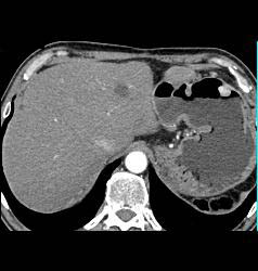 Metastatic Renal Cell Carcinoma to the Stomach - CTisus CT Scan