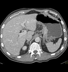 Infiltrating Gastric Cancer - CTisus CT Scan