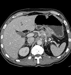 Infiltrating Gastric Cancer - CTisus CT Scan