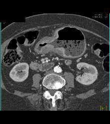 Infiltrating Gastric Cancer in Multiple Views - CTisus CT Scan