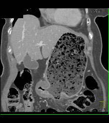 Infiltrating Gastric Cancer in Multiple Views - CTisus CT Scan