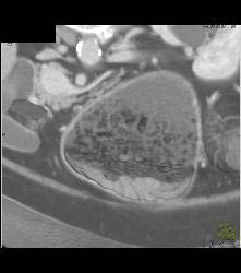 Infiltrating Gastric Cancer in Multiple Views - CTisus CT Scan