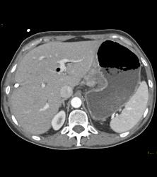 Gastric Carcinoma With Celiac Nodes - CTisus CT Scan
