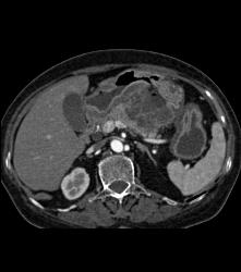 Bulky Gastric Adenocarcinoma - CTisus CT Scan