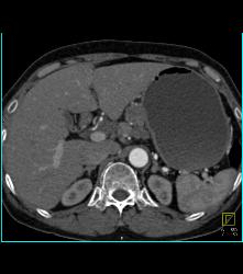 Antral Carcinoma With Celiac and Peri-portal Nodes - CTisus CT Scan