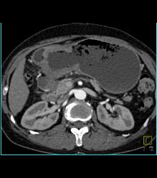 Antral Carcinoma With Celiac and Peri-portal Nodes - CTisus CT Scan