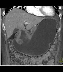 Antral Carcinoma With Celiac and Peri-portal Nodes - CTisus CT Scan