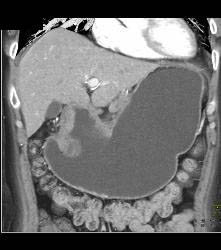 Antral Carcinoma With Celiac and Peri-portal Nodes - CTisus CT Scan