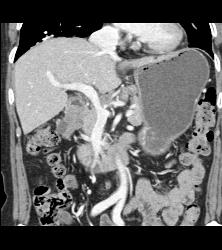 Antral Carcinoma With Celiac and Peri-portal Nodes - CTisus CT Scan