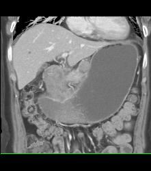 Antral Carcinoma With Celiac and Peri-portal Nodes - CTisus CT Scan