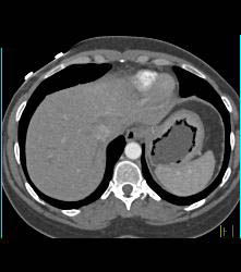 Bulky Gastric Cancer - CTisus CT Scan