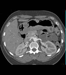 Bulky Gastric Cancer - CTisus CT Scan