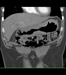 Bulky Gastric Cancer - CTisus CT Scan