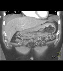 Bulky Gastric Cancer - CTisus CT Scan