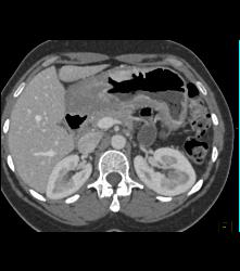 Bulky Gastric Cancer - CTisus CT Scan