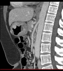 Bulky Gastric Cancer - CTisus CT Scan