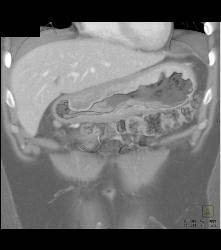 Bulky Gastric Cancer - CTisus CT Scan