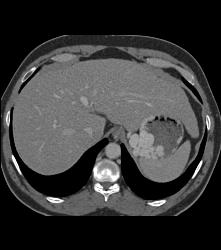 Gastric Varices Simulate A Tumor - CTisus CT Scan